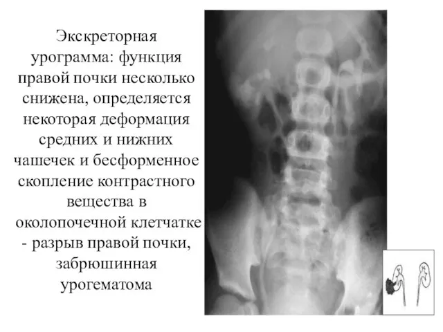 Экскреторная урограмма: функция правой почки несколько снижена, определяется некоторая деформация средних