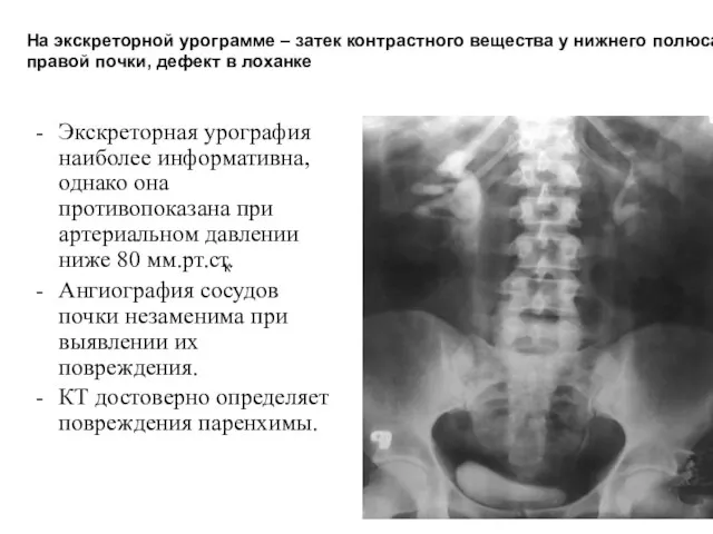 Экскреторная урография наиболее информативна, однако она противопоказана при артериальном давлении ниже