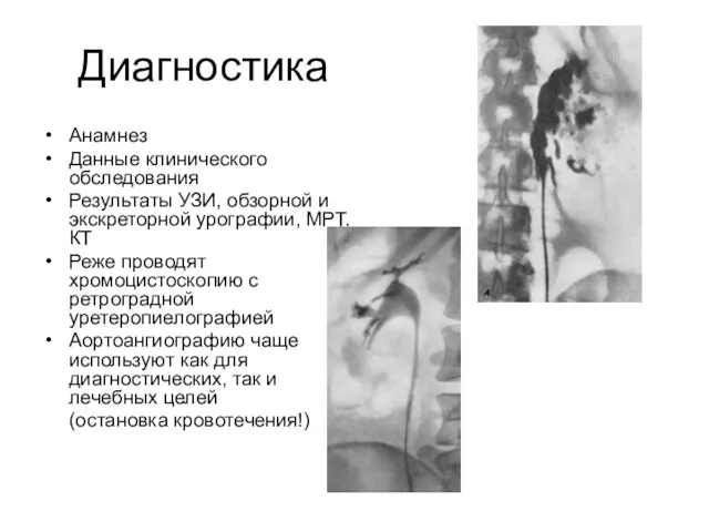 Диагностика Анамнез Данные клинического обследования Результаты УЗИ, обзорной и экскреторной урографии,