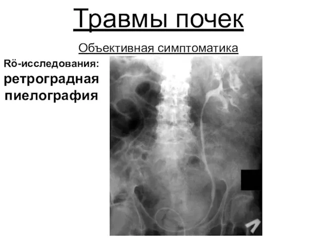 Травмы почек Объективная симптоматика Rö-исследования: ретроградная пиелография