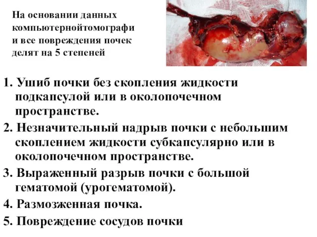 1. Ушиб почки без скопления жидкости подкапсулой или в околопочечном пространстве.