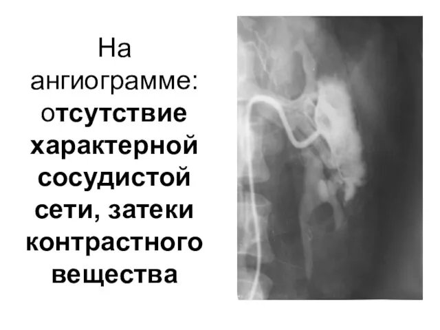 На ангиограмме: отсутствие характерной сосудистой сети, затеки контрастного вещества