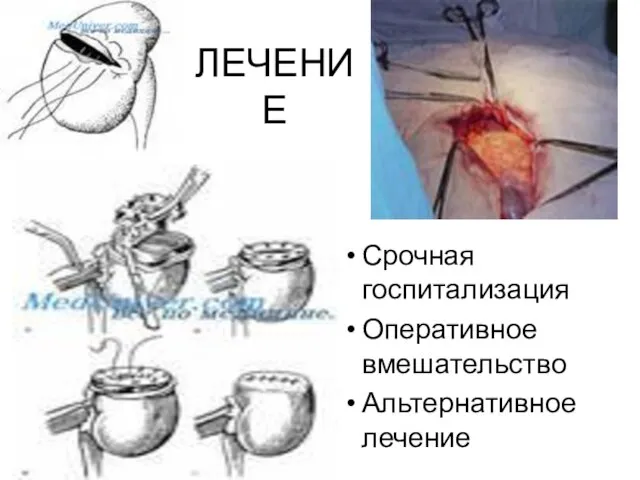 ЛЕЧЕНИЕ Срочная госпитализация Оперативное вмешательство Альтернативное лечение