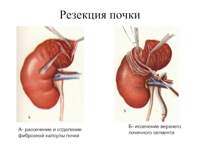 Резекция почки Б- иссечение верхнего почечного сегмента А- рассечение и отделение фиброзной капсулы почки