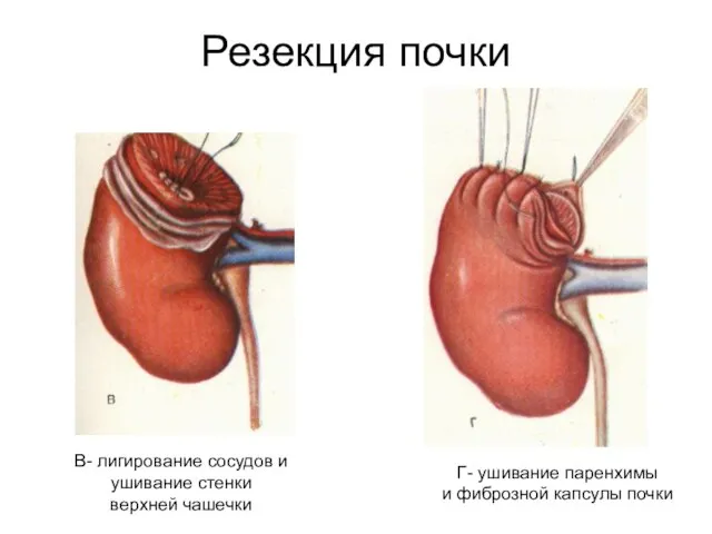 Резекция почки Г- ушивание паренхимы и фиброзной капсулы почки В- лигирование