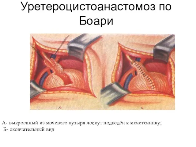 Уретероцистоанастомоз по Боари А- выкроенный из мочевого пузыря лоскут подведён к мочеточнику; Б- окончательный вид