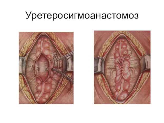 Уретеросигмоанастомоз