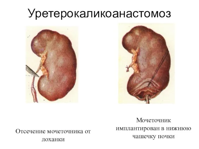 Уретерокаликоанастомоз Отсечение мочеточника от лоханки Мочеточник имплантирован в нижнюю чашечку почки