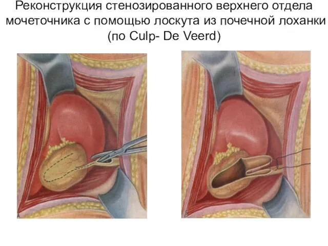 Реконструкция стенозированного верхнего отдела мочеточника с помощью лоскута из почечной лоханки (по Culp- De Veerd)