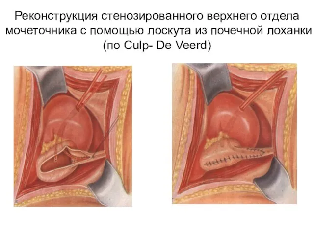 Реконструкция стенозированного верхнего отдела мочеточника с помощью лоскута из почечной лоханки (по Culp- De Veerd)