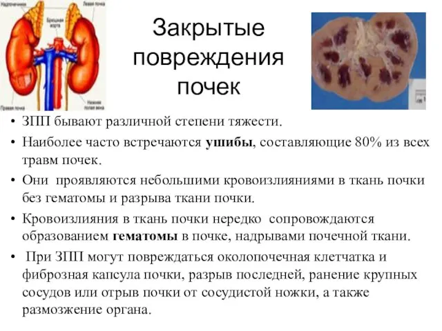 Закрытые повреждения почек ЗПП бывают различной степени тяжести. Наиболее часто встречаются