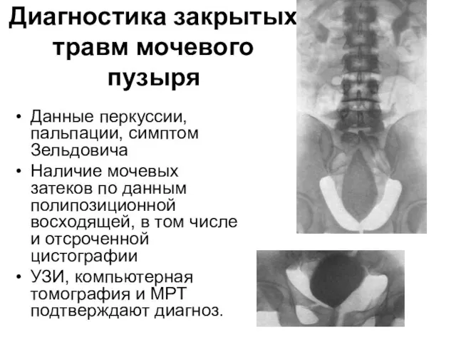 Диагностика закрытых травм мочевого пузыря Данные перкуссии, пальпации, симптом Зельдовича Наличие