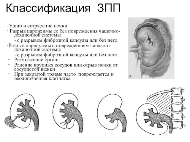 Классификация ЗПП ∙ Ушиб и сотрясение почки ∙ Разрыв паренхимы ее