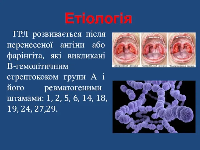 Етіологія ГРЛ розвивається після перенесеної ангіни або фарінгіта, які викликані В-гемолітичним