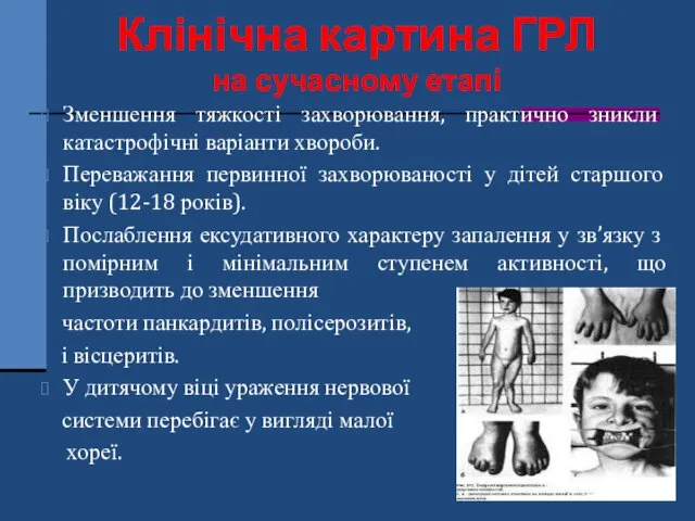 Клінічна картина ГРЛ на сучасному етапі Зменшення тяжкості захворювання, практично зникли