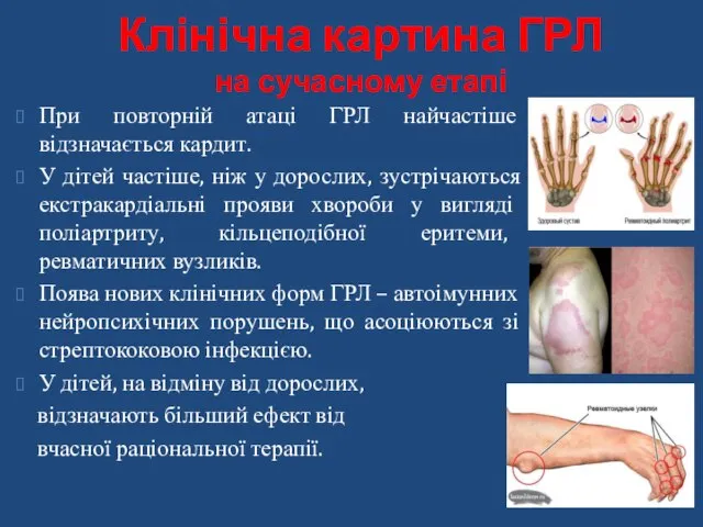 Клінічна картина ГРЛ на сучасному етапі При повторній атаці ГРЛ найчастіше