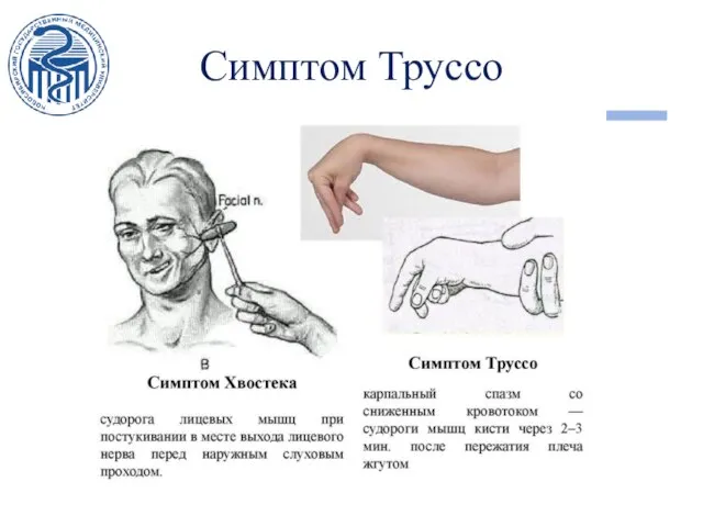 Симптом Труссо