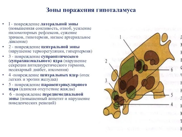 Зоны поражения гипоталамуса I - повреждение латеральной зоны (повышенная сонливость, озноб,