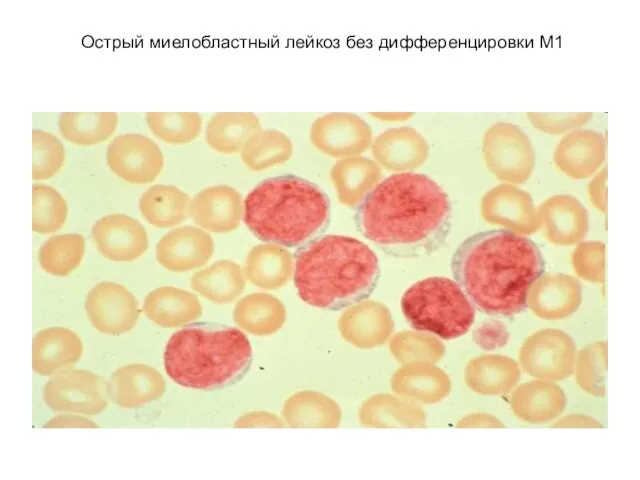 Острый миелобластный лейкоз без дифференцировки М1