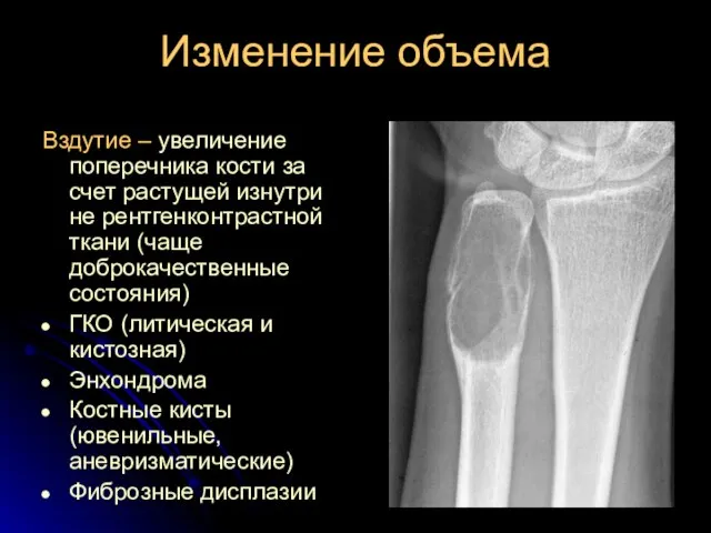 Изменение объема Вздутие – увеличение поперечника кости за счет растущей изнутри