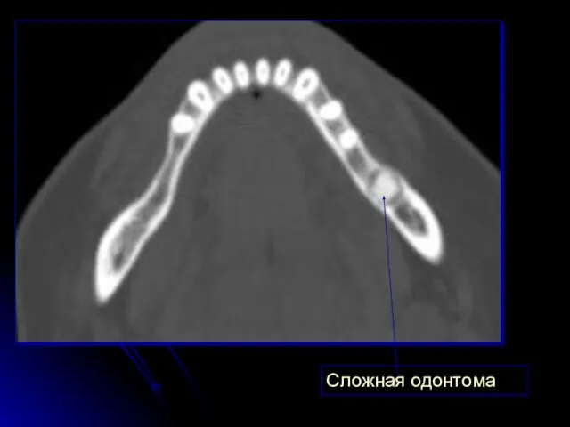 Сложная одонтома