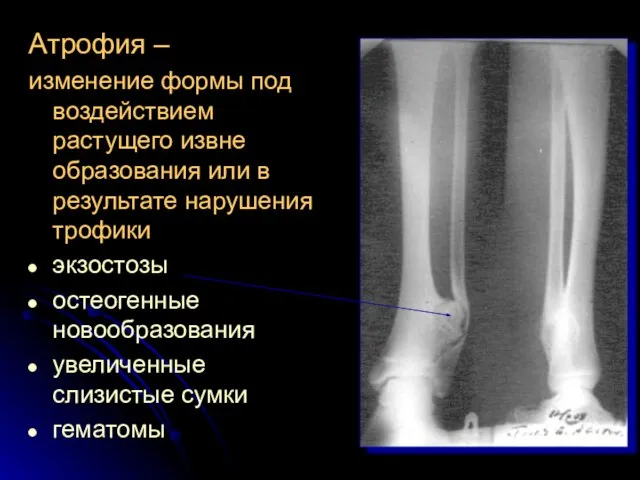 Атрофия – изменение формы под воздействием растущего извне образования или в