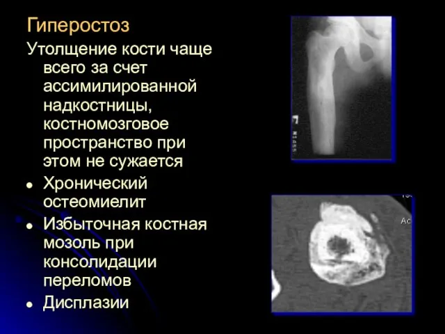 Гиперостоз Утолщение кости чаще всего за счет ассимилированной надкостницы, костномозговое пространство