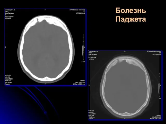 Болезнь Пэджета