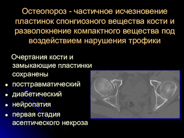 Остеопороз - частичное исчезновение пластинок спонгиозного вещества кости и разволокнение компактного