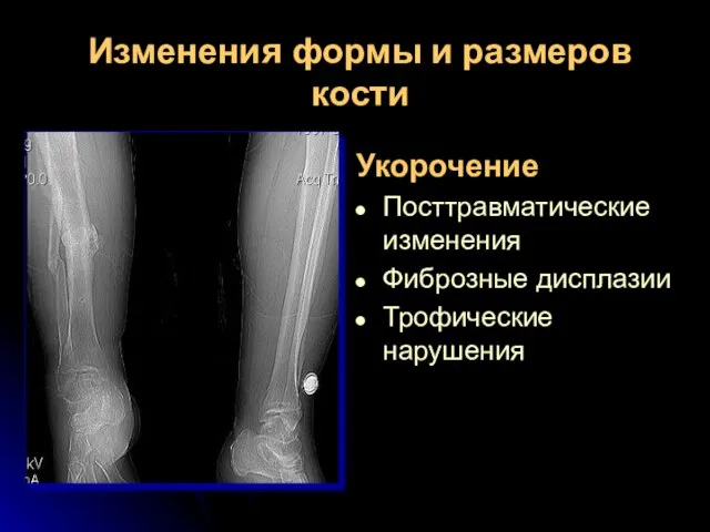 Укорочение Посттравматические изменения Фиброзные дисплазии Трофические нарушения Изменения формы и размеров кости