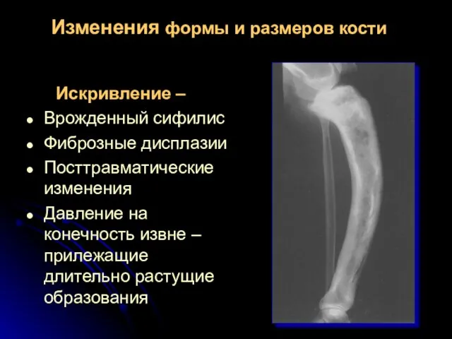 Искривление – Врожденный сифилис Фиброзные дисплазии Посттравматические изменения Давление на конечность