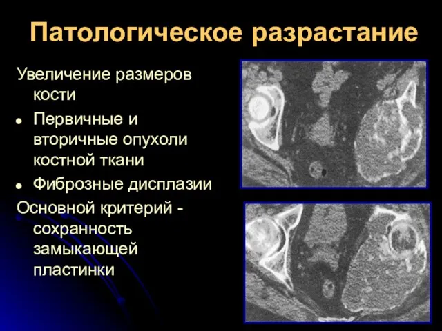 Патологическое разрастание Увеличение размеров кости Первичные и вторичные опухоли костной ткани