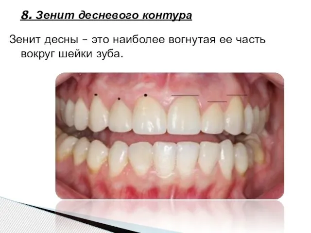 8. Зенит десневого контура Зенит десны – это наиболее вогнутая ее часть вокруг шейки зуба.