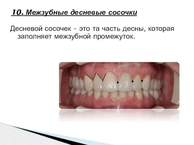 10. Межзубные десневые сосочки Десневой сосочек – это та часть десны, которая заполняет межзубной промежуток.