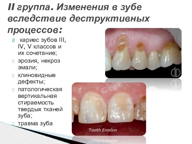 кариес зубов III, IV, V классов и их сочетание; эрозия, некроз