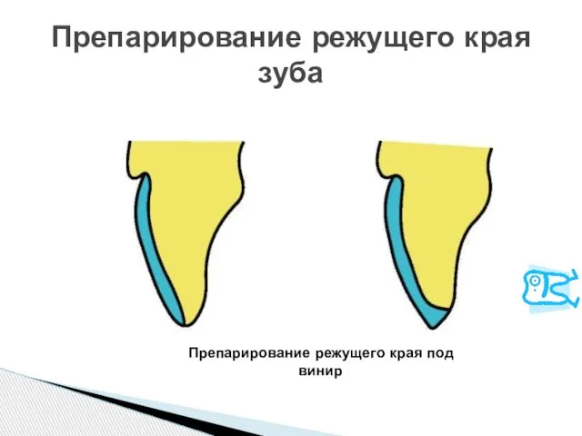 Препарирование режущего края зуба Препарирование режущего края под винир