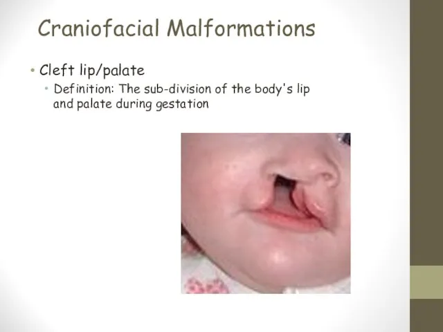 Craniofacial Malformations Cleft lip/palate Definition: The sub-division of the body's lip and palate during gestation