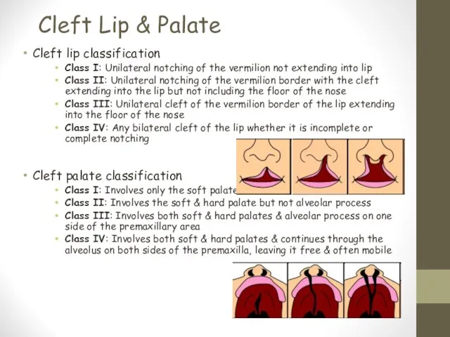 Cleft Lip & Palate Cleft lip classification Class I: Unilateral notching