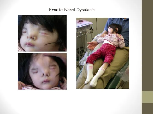 Fronto-Nasal Dysplasia