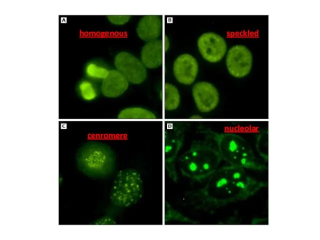 homogenous nucleolar speckled cenromere