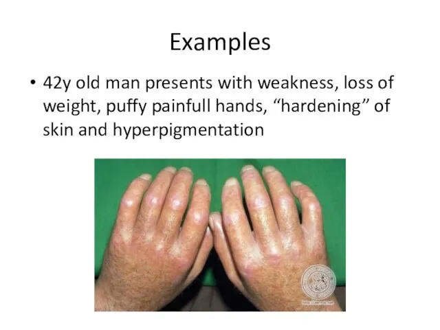 Examples 42y old man presents with weakness, loss of weight, puffy