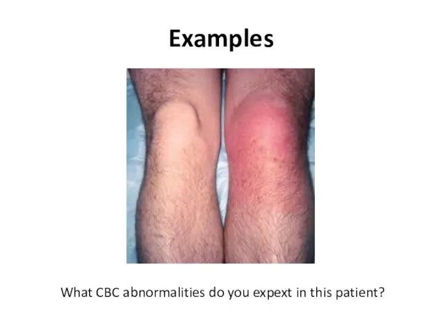 Examples What CBC abnormalities do you expext in this patient?