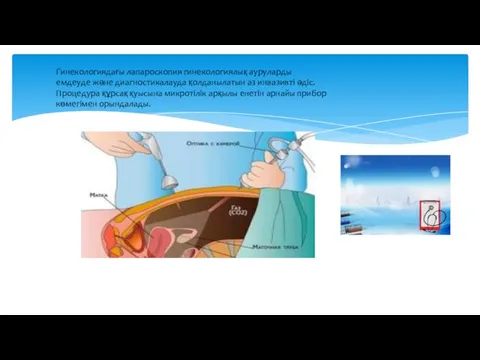 Гинекологиядағы лапароскопия гинекологиялық ауруларды емдеуде және диагностикалауда қолданылатын аз инвазивті әдіс.
