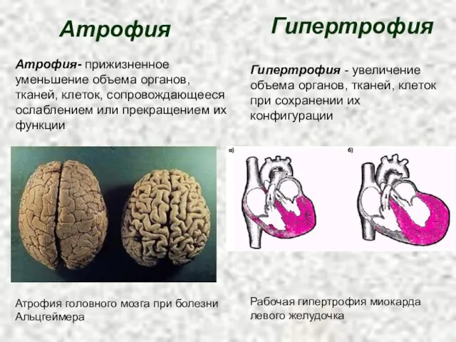 Атрофия Атрофия- прижизненное уменьшение объема органов, тканей, клеток, сопровождающееся ослаблением или