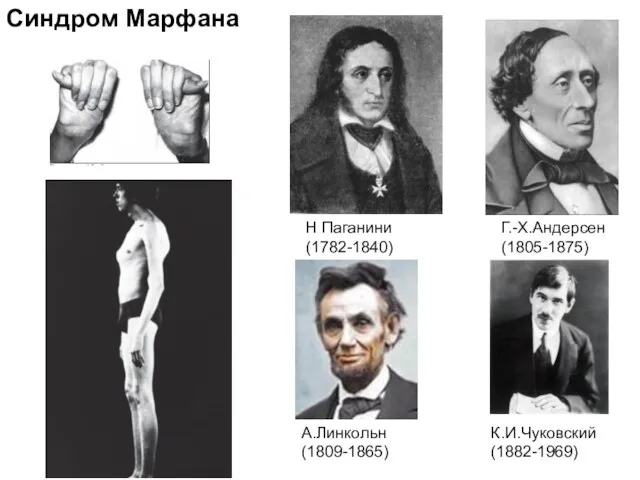 Н Паганини (1782-1840) Г.-Х.Андерсен (1805-1875) К.И.Чуковский (1882-1969) А.Линкольн (1809-1865) Синдром Марфана