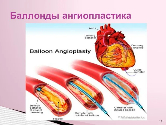 Баллонды ангиопластика