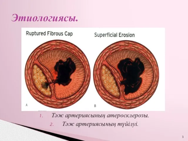 Тәж артериясының атеросклерозы. Тәж артериясының түйілуі. Этиологиясы.