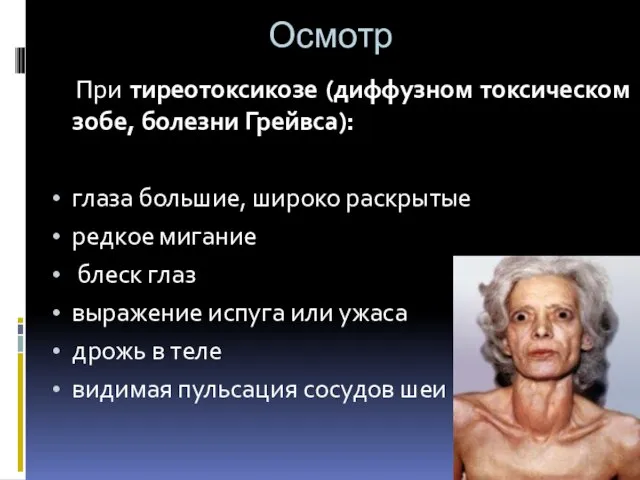 Осмотр При тиреотоксикозе (диффузном токсическом зобе, болезни Грейвса): глаза большие, широко