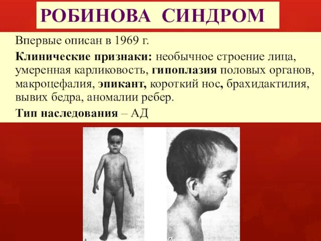 РОБИНОВА СИНДРОМ Впервые описан в 1969 г. Клинические признаки: необычное строение