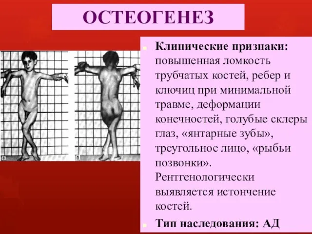 ОСТЕОГЕНЕЗ Клинические признаки: повышенная ломкость трубчатых костей, ребер и ключиц при